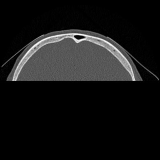 File:Base of skull chondrosarcoma (Radiopaedia 30410-31071 Axial bone window 48).jpg