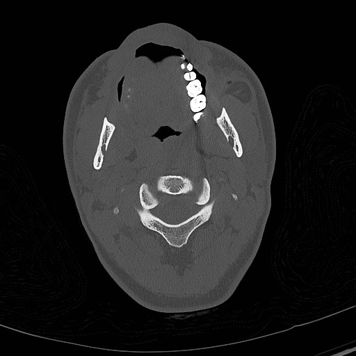 Base of skull fracture with bilateral Le Fort fractures (Radiopaedia 47094-51638 Axial bone window 8).jpg