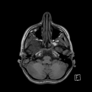 Base of skull rhabdomyosarcoma (Radiopaedia 32196-33142 Axial T1 10).jpg