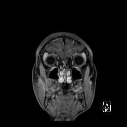 Base of skull rhabdomyosarcoma (Radiopaedia 32196-33142 I 19).jpg