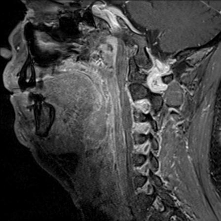Base of tongue squamous cell carcinoma (Radiopaedia 31174-31884 F 71).jpg