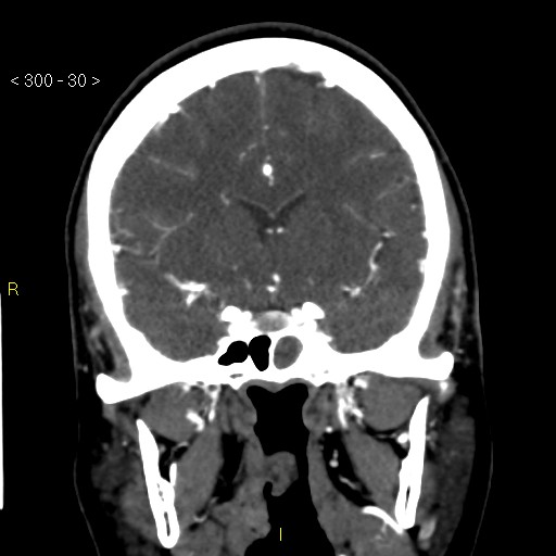 Basilar artery thrombosis (Radiopaedia 16260-15944 B 21).jpg