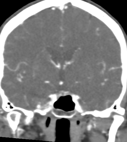 Basilar tip aneurysm with coiling (Radiopaedia 53912-60086 B 70).jpg