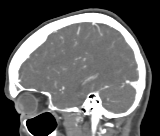 Basilar tip aneurysm with coiling (Radiopaedia 53912-60086 C 32).jpg