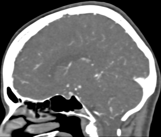 Basilar tip aneurysm with coiling (Radiopaedia 53912-60086 C 58).jpg