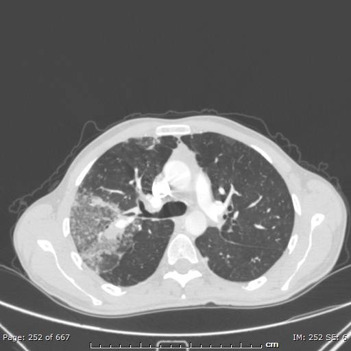 Behçet disease (Radiopaedia 44247-47889 Axial lung window 31).jpg