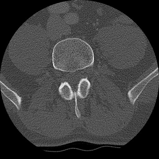 Benign post-traumatic pseudopneumoperitoneum (Radiopaedia 71199-81495 Axial bone window 260).jpg