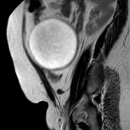 File:Benign seromucinous cystadenoma of the ovary (Radiopaedia 71065-81300 Sagittal T2 5).jpg