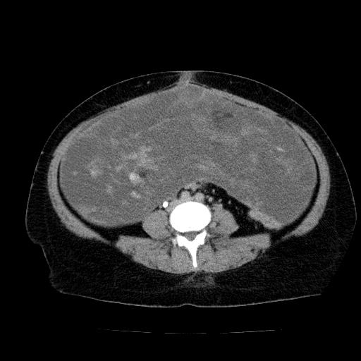 Benign spindle cell tumor - abdominopelvic (Radiopaedia 61300-69212 Axial C+ delayed 38).jpg