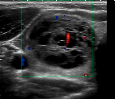 File:Benign thyroid lesion (ultrasound) (Radiopaedia 21889).png