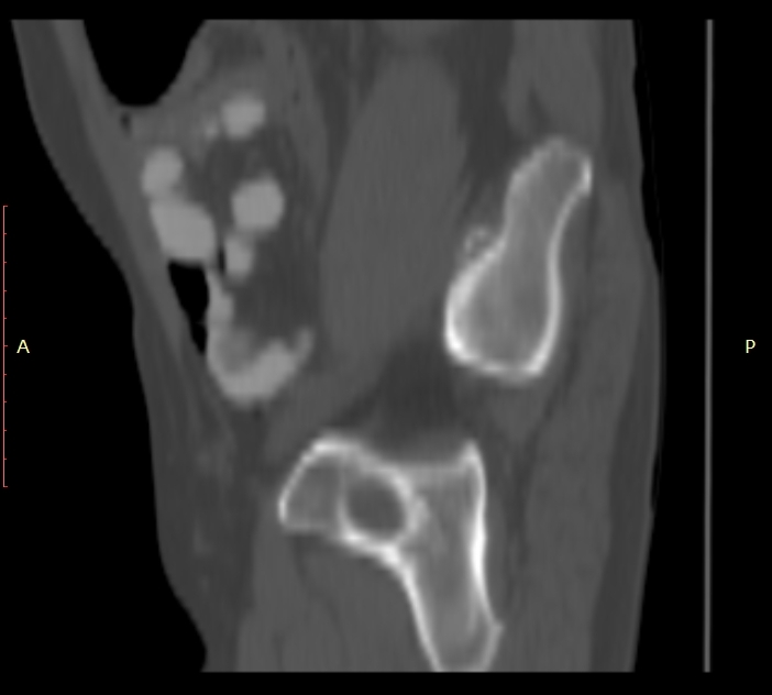 Bertolotti syndrome (Radiopaedia 58974-66235 Sagittal bone window 56).jpg