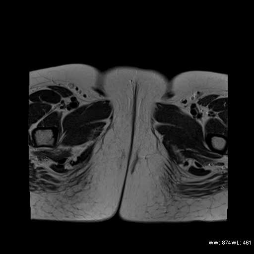 File:Bicornuate uterus- on MRI (Radiopaedia 49206-54297 Axial T2 21).jpg