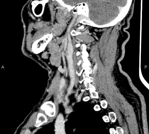 Bilateral Warthin tumors (Radiopaedia 84034-99263 D 32).jpg