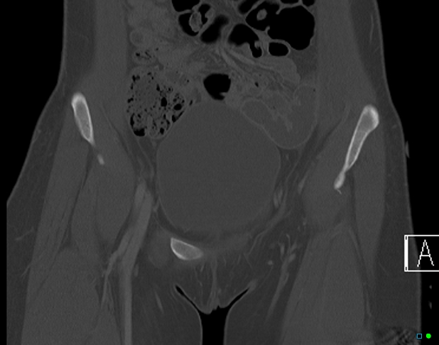 File:Bilateral acetabular fractures (Radiopaedia 79272-92308 Coronal bone window 4).jpg