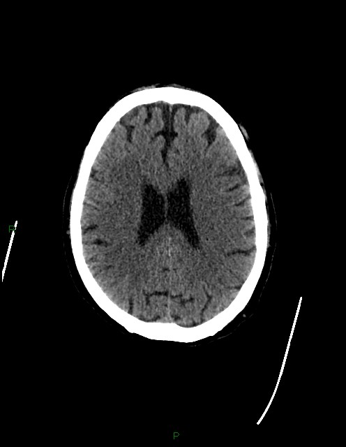 Bilateral acute middle cerebral artery territory infarcts (Radiopaedia 77319-89401 Axial non-contrast 57).jpg