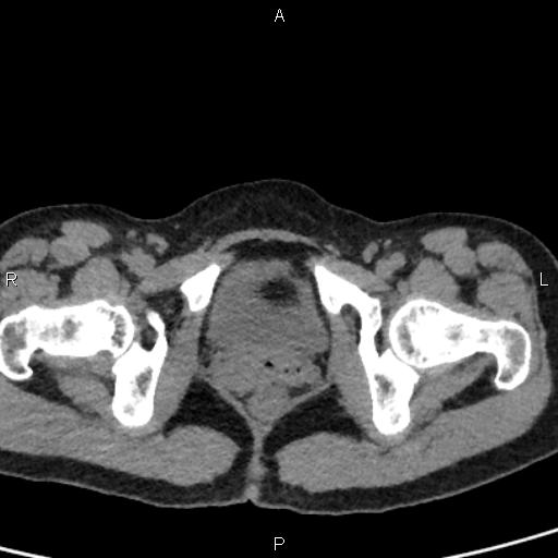 Bilateral adrenal gland hyperenhancement in pancreatitis (Radiopaedia 86642-102753 Axial non-contrast 108).jpg