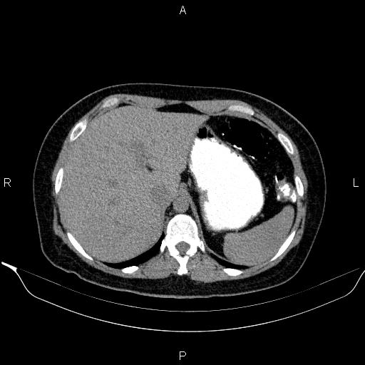 Bilateral adrenal myelolipoma (Radiopaedia 63058-71535 Axial non-contrast 32).jpg