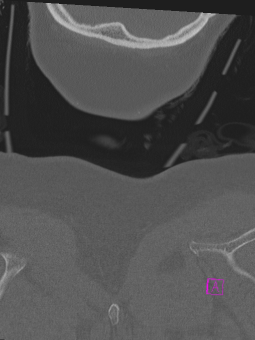 Bilateral atlanto-occipital assimilation (Radiopaedia 28350-28603 Coronal bone window 62).jpg
