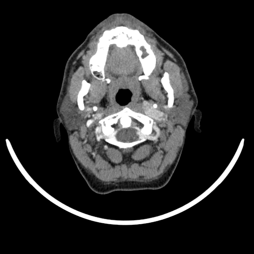 Bilateral carotid body tumors (Radiopaedia 52899-58827 A 41).jpg