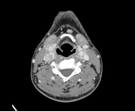 Bilateral carotid body tumors (Radiopaedia 61841-69870 Axial Post contrast 59).jpg