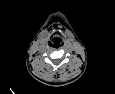 Bilateral carotid body tumors (Radiopaedia 61841-69870 Axial non-contrast 60).jpg