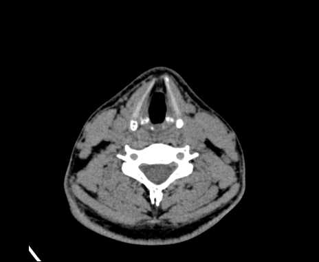 Bilateral carotid body tumors (Radiopaedia 61841-69870 Axial non-contrast 69).jpg