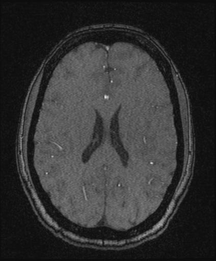 Bilateral carotid body tumors and right glomus jugulare tumor (Radiopaedia 20024-20060 Axial MRA 117).jpg