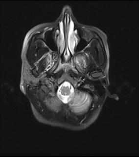 File:Bilateral carotid body tumors and right jugular paraganglioma (Radiopaedia 20024-20060 Axial 28).jpg