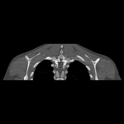 File:Bilateral chronic posterior shoulder dislocation (Radiopaedia 39213-41452 Coronal bone window 48).jpg