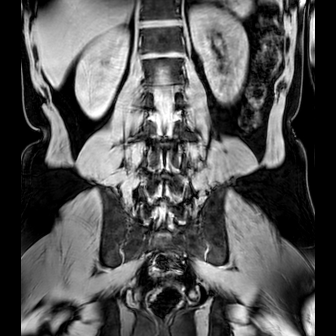 Bilateral conjoined nerve roots at different levels (Radiopaedia 73312-84063 Coronal WE 35).jpg