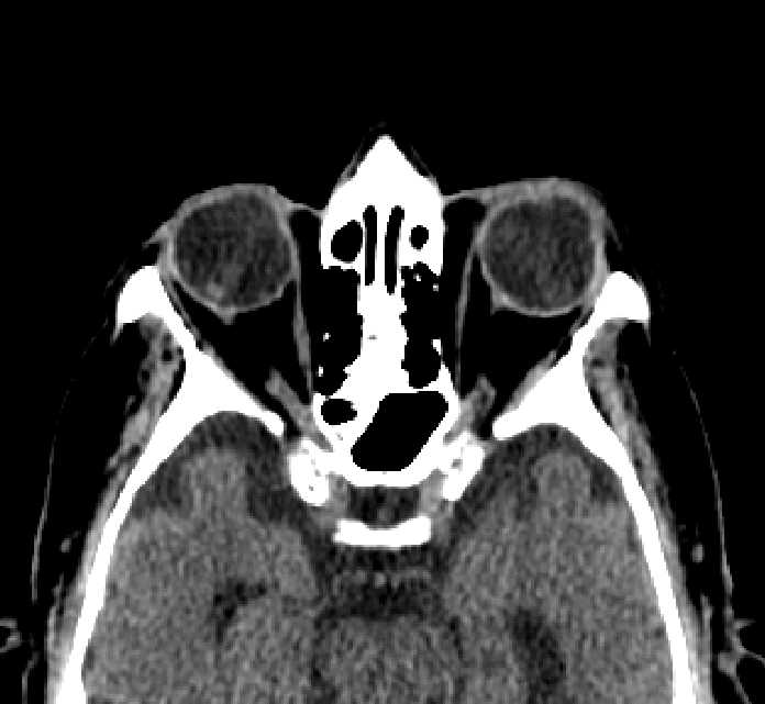 Bilateral ectopia lentis (Radiopaedia 89889-107013 Axial non-contrast 38).jpg