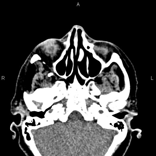 Bilateral enlargement of lacrimal glands - sarcoidosis (Radiopaedia 62627-70921 Axial non-contrast 25).jpg