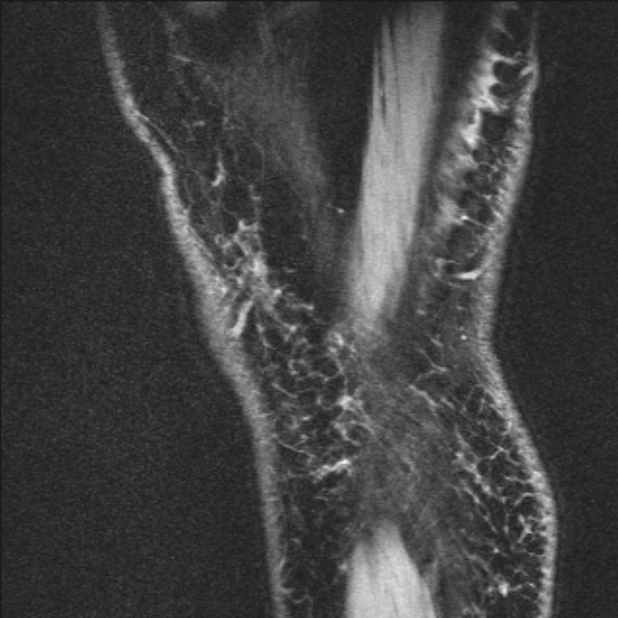 Bilateral focal pigmented villonodular synovitis (Radiopaedia 67643-77046 G 63).jpg