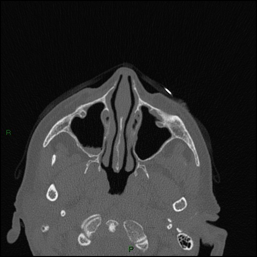 File:Bilateral frontal mucoceles (Radiopaedia 82352-96454 Axial bone window 192).jpg