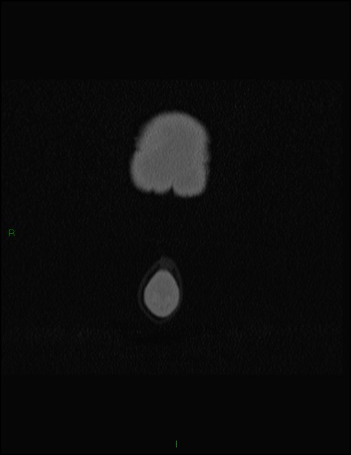 Bilateral frontal mucoceles (Radiopaedia 82352-96454 Coronal 7).jpg