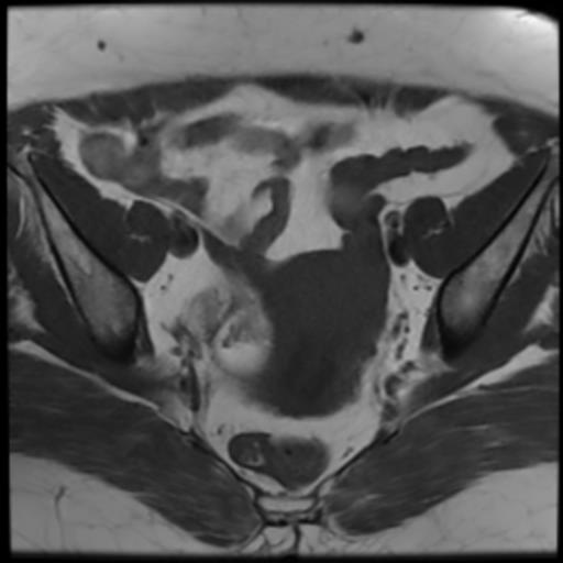 File:Bilateral ovarian dermoid cysts (Radiopaedia 90152-107338 Axial T1 11).jpg