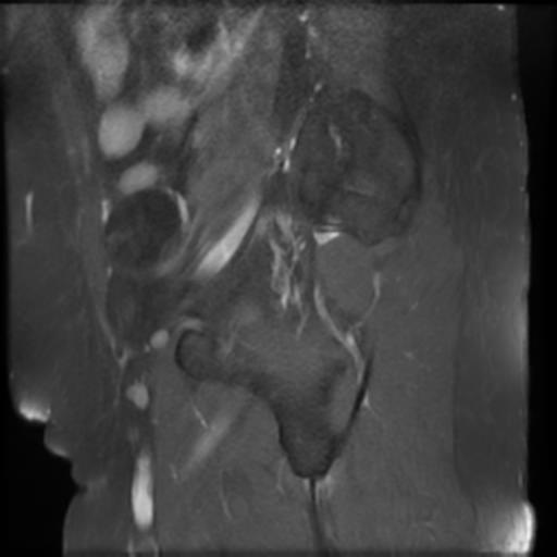 File:Bilateral ovarian dermoid cysts (Radiopaedia 90152-107338 Sagittal T1 C+ 21).jpg