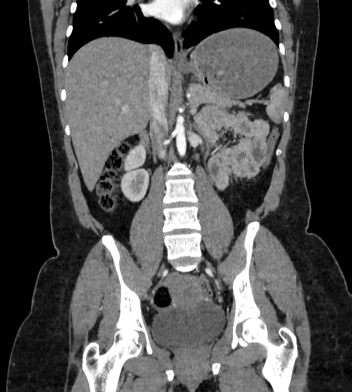 File:Bilateral ovarian mature cystic teratomas (Radiopaedia 79373-92457 B 41).jpg