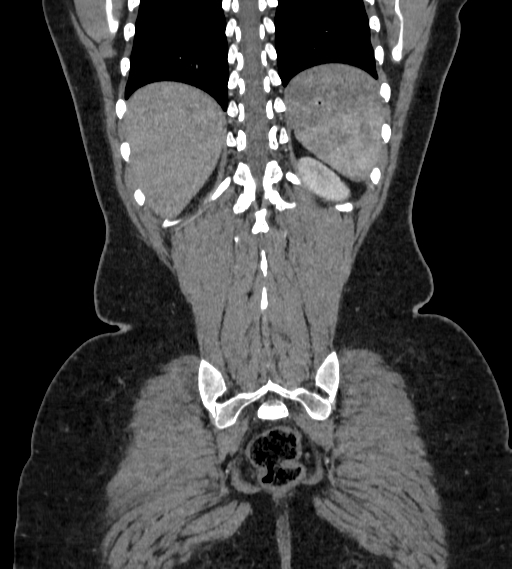 Bilateral ovarian mature cystic teratomas (Radiopaedia 79373-92457 B 90).jpg