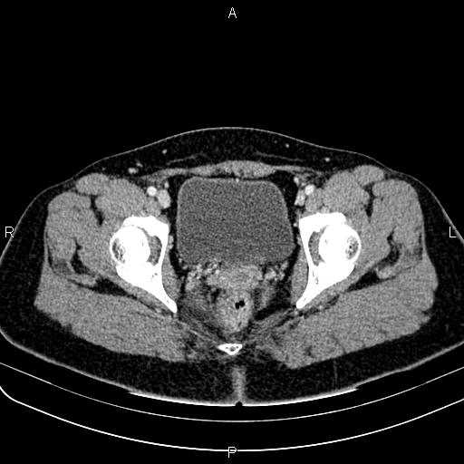 Bilateral ovarian teratoma (Radiopaedia 83131-97503 Axial With contrast 64).jpg