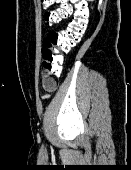 Bilateral ovarian teratoma (Radiopaedia 83131-97503 D 35).jpg