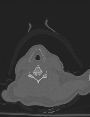 Bilateral perched facet joint (Radiopaedia 63149-71669 Axial bone window 39).jpg