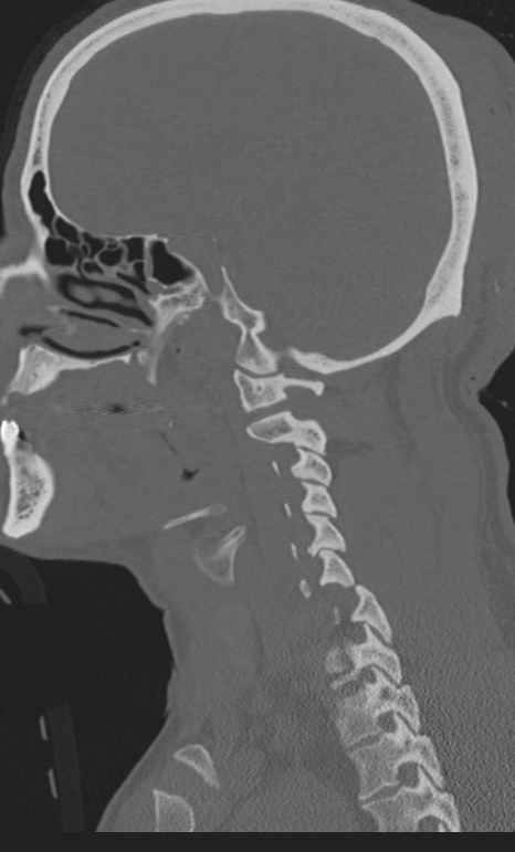 Bilateral perched facet joint (Radiopaedia 63149-71669 Sagittal bone window 9).jpg