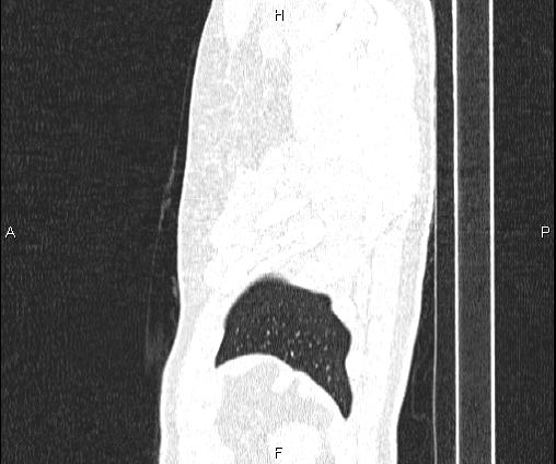 Bilateral pulmonary AVM (Radiopaedia 83134-97505 Sagittal lung window 105).jpg