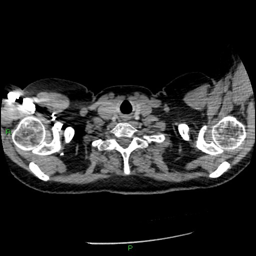 Bilateral pulmonary emboli (Radiopaedia 32700-33669 Axial C+ CTPA 3).jpg