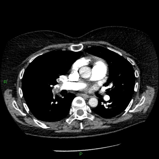 Bilateral pulmonary emboli (Radiopaedia 32700-33669 Axial C+ CTPA 53).jpg