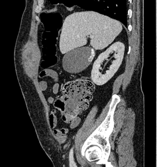 Bilateral rectus sheath hematomas (Radiopaedia 50778-56252 B 25).jpg