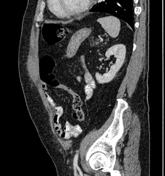 Bilateral rectus sheath hematomas (Radiopaedia 50778-56252 B 58).jpg