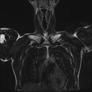 Bilateral spinoglenoid notch ganglion cysts (Radiopaedia 29577-30082 Coronal T2 27).jpg