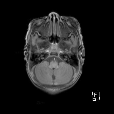File:Bilateral subdural hemorrhage and parietal skull fracture (Radiopaedia 26058-26190 Axial T1 10).png